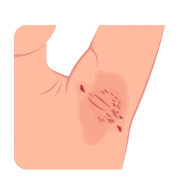 melocare Acne