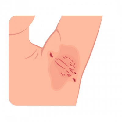 melocare Acne